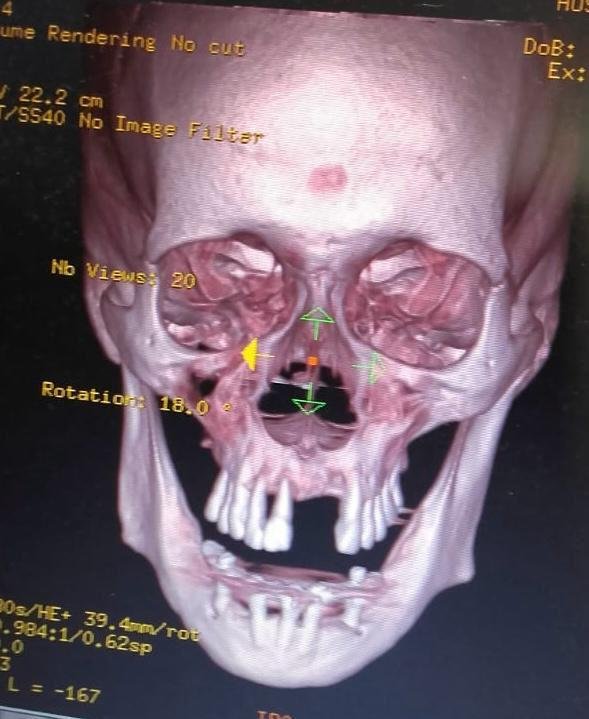 estudo-de-caso-odontologia-hospitalar-no-pre-transplante