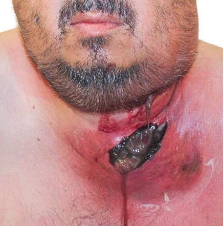 Mediastinite-Odontogenica-Revista-JBCOMS